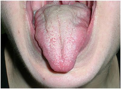 MuSK-Associated Myasthenia Gravis: Clinical Features and Management